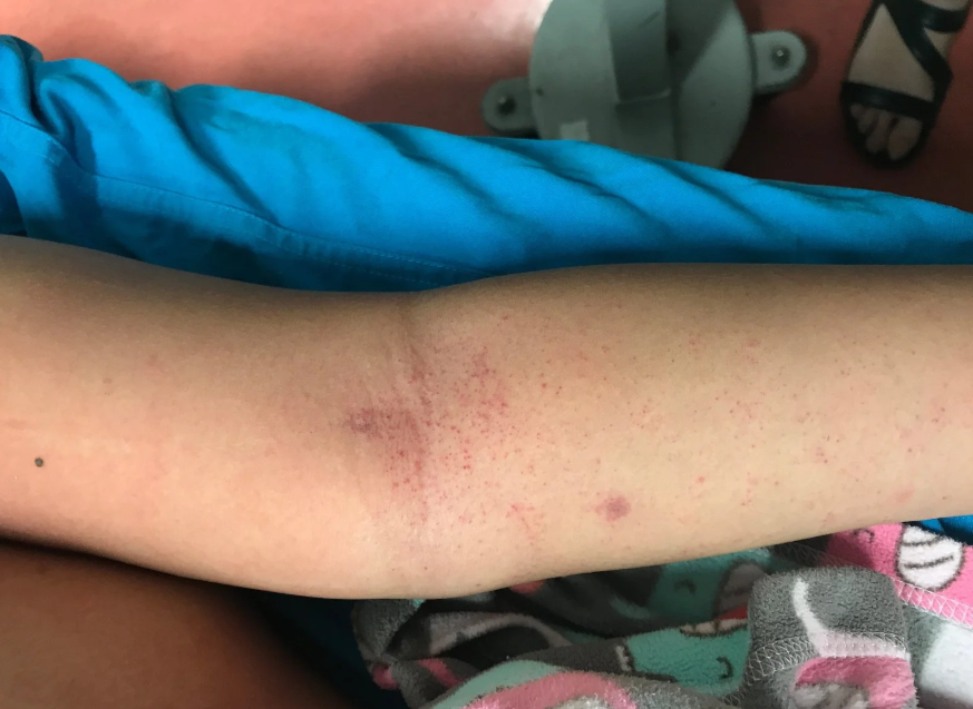 Red Flag For Rash Infant Rash Red Flags: The two rashes every parent must recognise – And ...