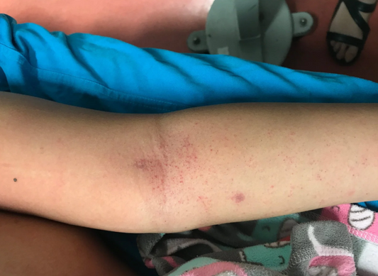 Infant Rash Red Flags: The two rashes every parent must recognise